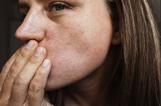 Which Skincare Service is Right for Acne, Dryness, or Sensitive Skin?